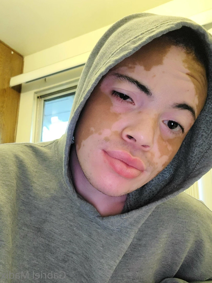 Gabriel [ vitiligoftmboi ] Onlyfans leaked photo 17684592 on Hotleaks.tv