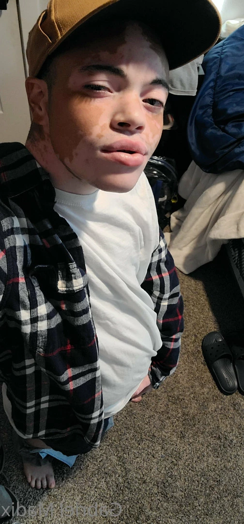Gabriel [ vitiligoftmboi ] Onlyfans leaked photo 17684628 on Hotleaks.tv